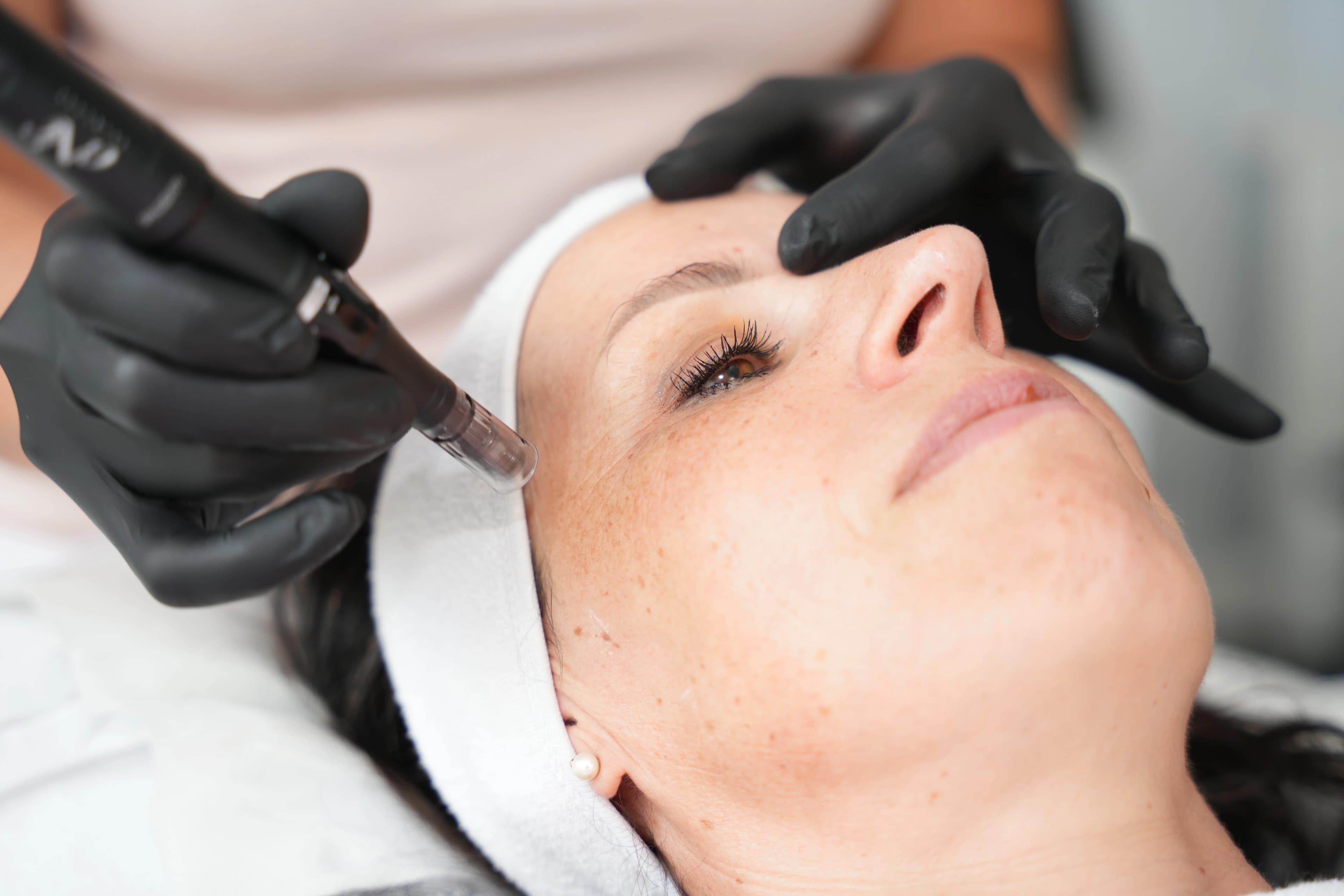 Erlebnispaket Microneedling – Bild 8