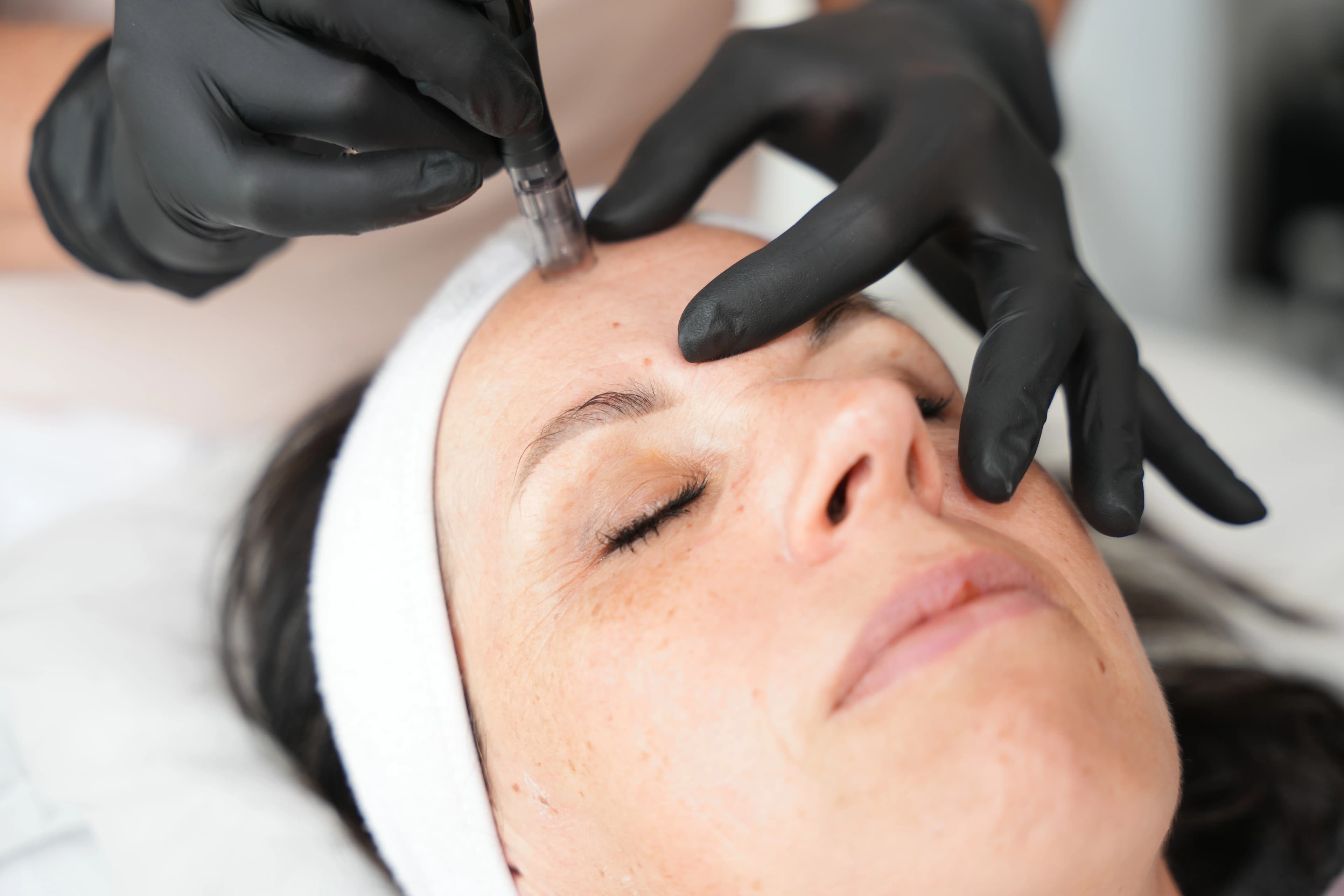 Erlebnispaket Microneedling – Bild 9
